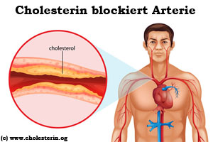 Cholesterin blockt Arterie